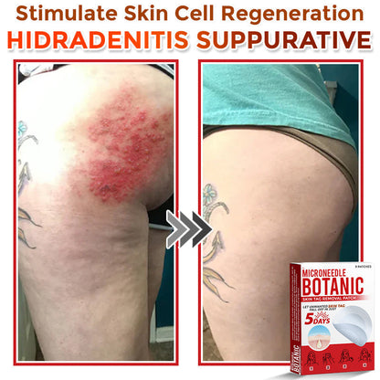 🌈MicroNeedle Botanic Skin Tag Removal Patch|Made in the USA